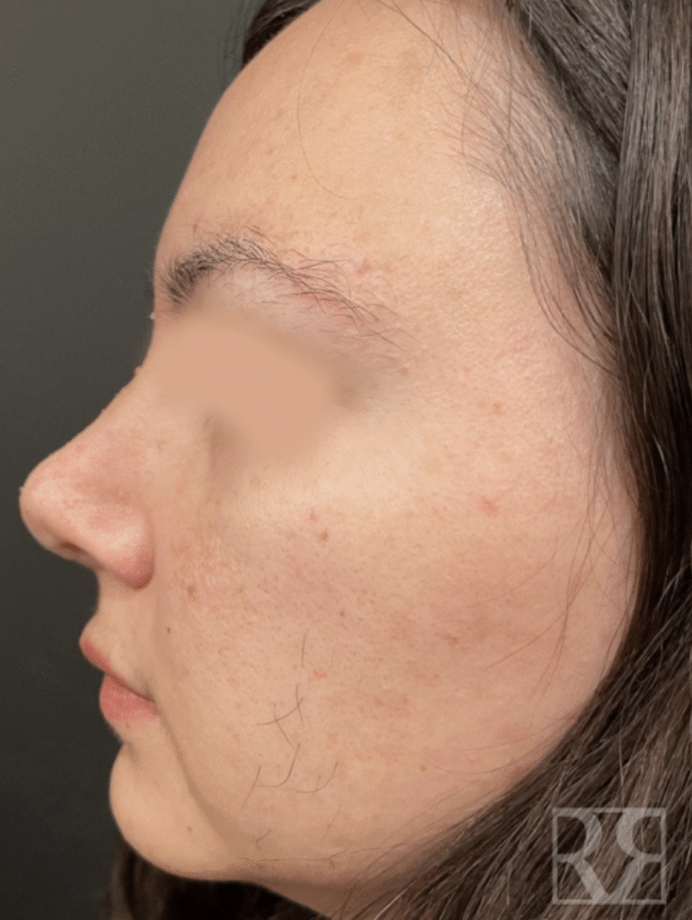 1741906052-female-1-after-2x 1741906052 female 1 after 2x