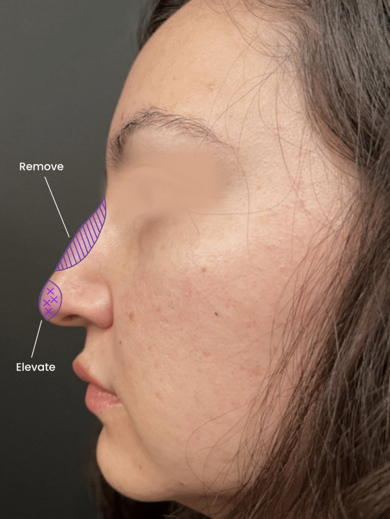 1741906052-female-1-before-2x 1741906052 female 1 before 2x