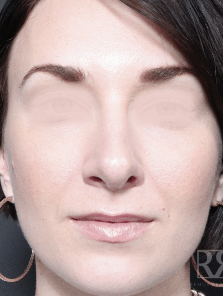 1741906052-female-3-after-2x 1741906052 female 3 after 2x