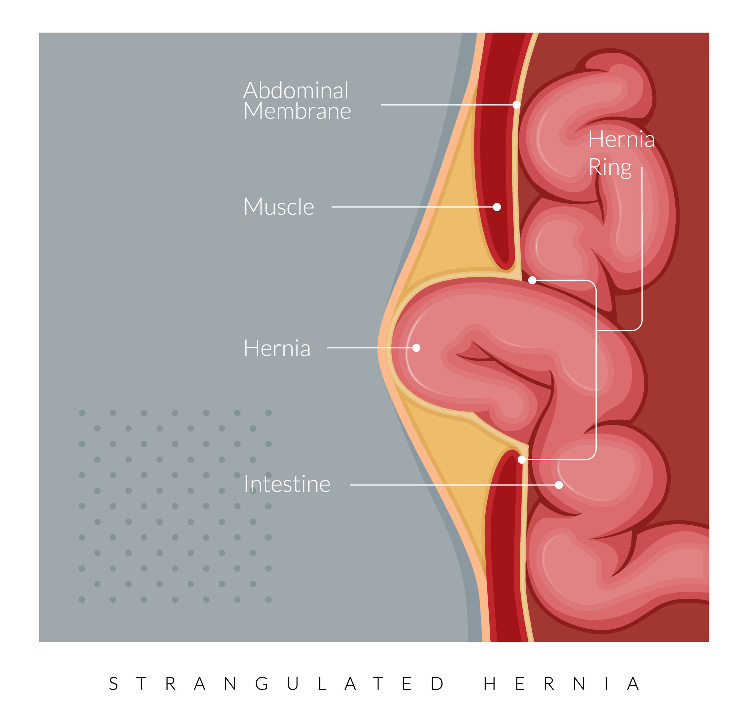 Strangulated Hernia - Section of the Small Intestines - Stock Illustration iStock 1551510154 scaled